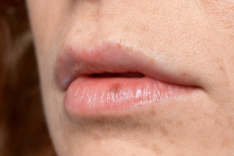 Herpes labial Herpes labial