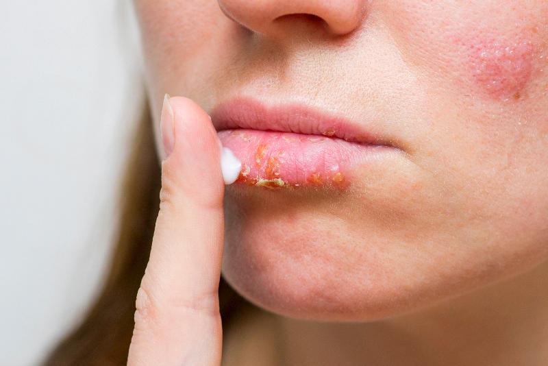 Brote herpes labial