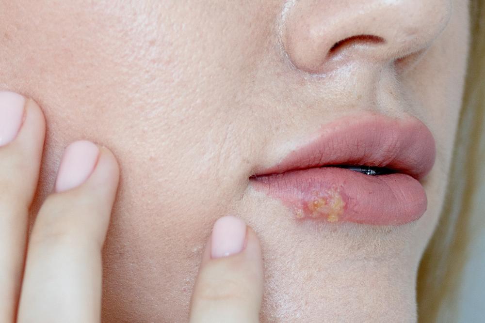 Herpes labial