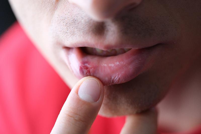 Virus herpes simple