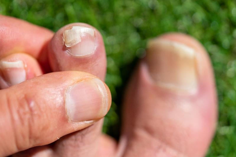 Causas de los hongos en las uñas Causas de los hongos en las uñas