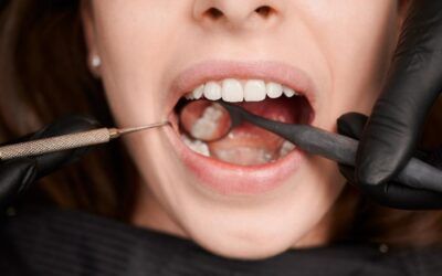 Caries dental: Causas y tratamiento