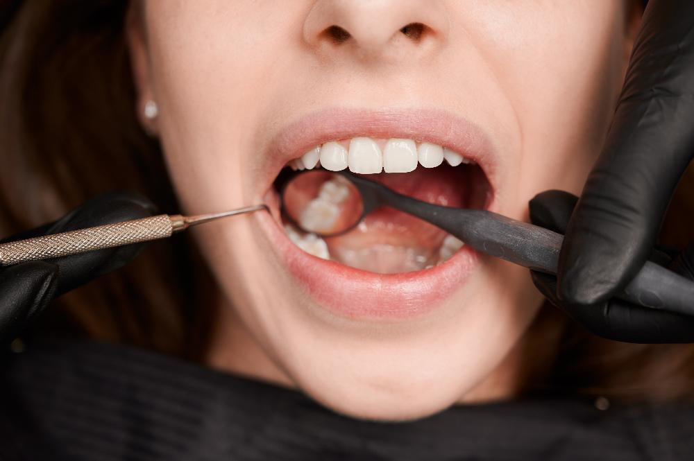 Caries Caries