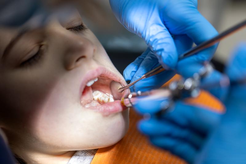 Tratamiento para la caries Tratamiento para la caries