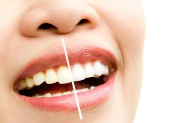 ¿Cuál es el blanqueador de dientes más efectivo?