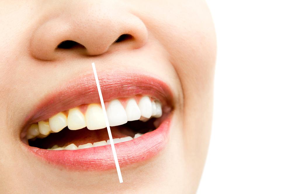 Escoger blanqueador dental Escoger blanqueador dental
